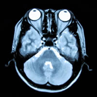 脳のMRI写真（横断面）