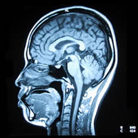 脳のMRI写真（矢断面）